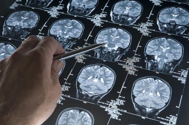 Glioblastoma in 15-39 year-olds: 230% increase in 20 years! – Article